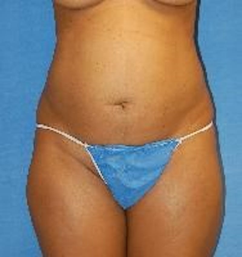 Liposuction Before & After Gallery - Patient 90404967 - Image 1
