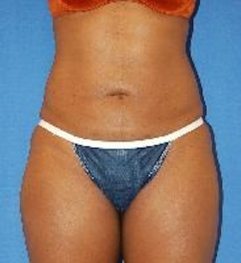 Liposuction Before & After Gallery - Patient 90404967 - Image 2
