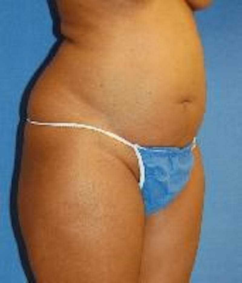 Liposuction Before & After Gallery - Patient 90404967 - Image 3