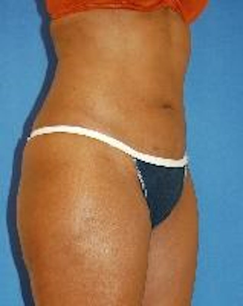 Liposuction Before & After Gallery - Patient 90404967 - Image 4
