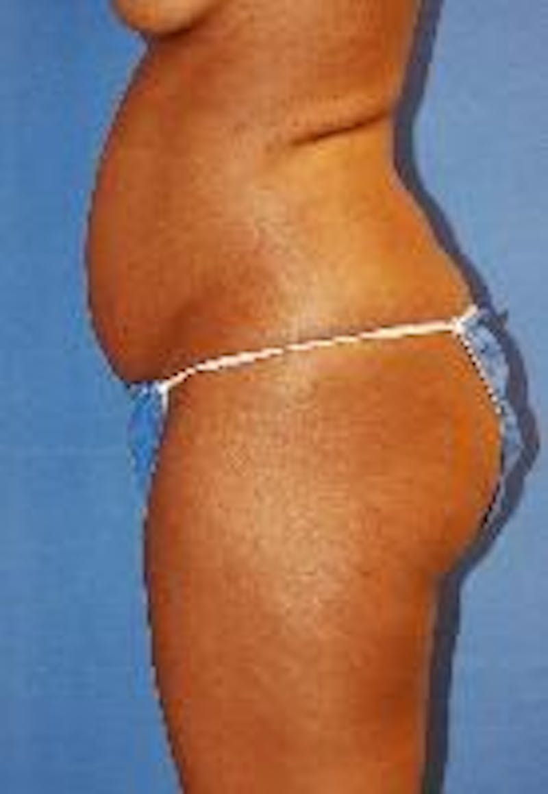 Liposuction Before & After Gallery - Patient 90404967 - Image 5