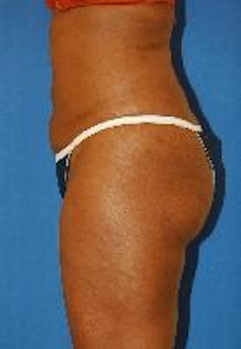 Liposuction Before & After Gallery - Patient 90404967 - Image 6