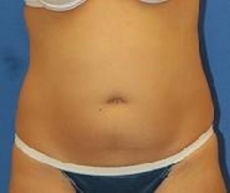 Liposuction Before & After Gallery - Patient 90404972 - Image 1
