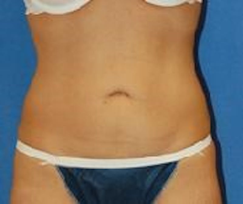 Liposuction Before & After Gallery - Patient 90404972 - Image 2