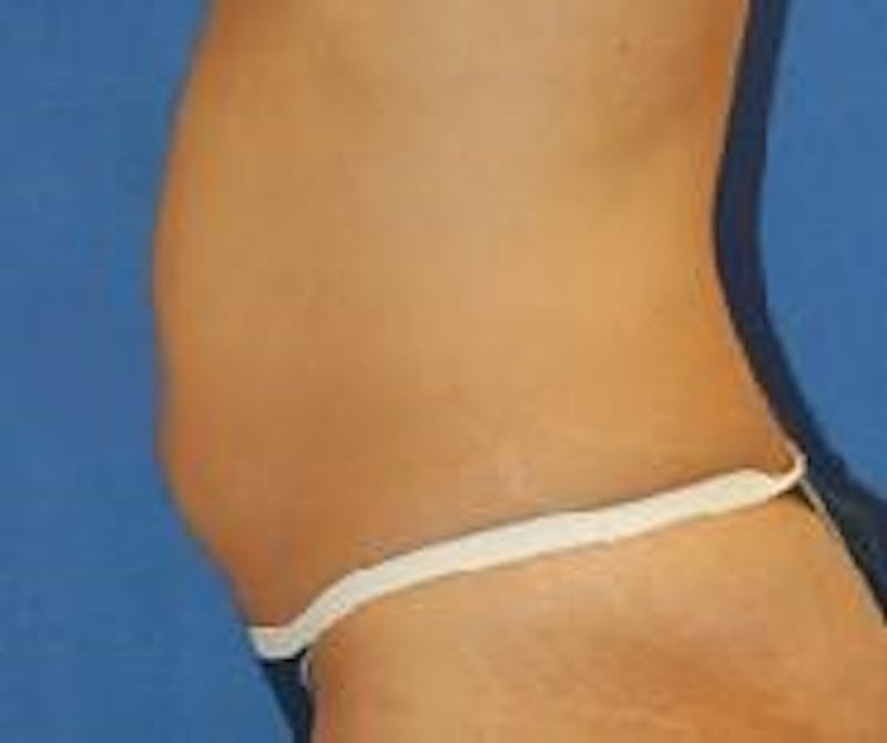 Liposuction Before & After Gallery - Patient 90404972 - Image 3