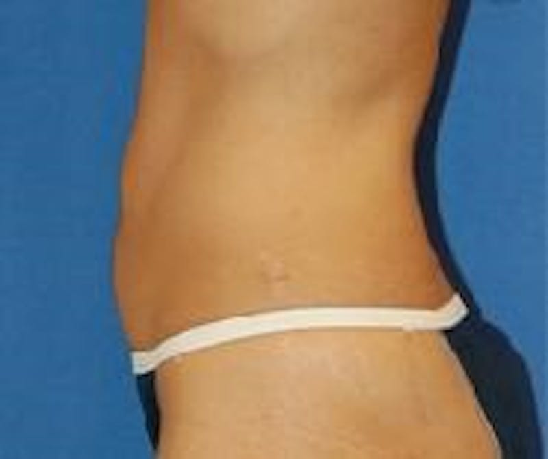 Liposuction Before & After Gallery - Patient 90404972 - Image 4