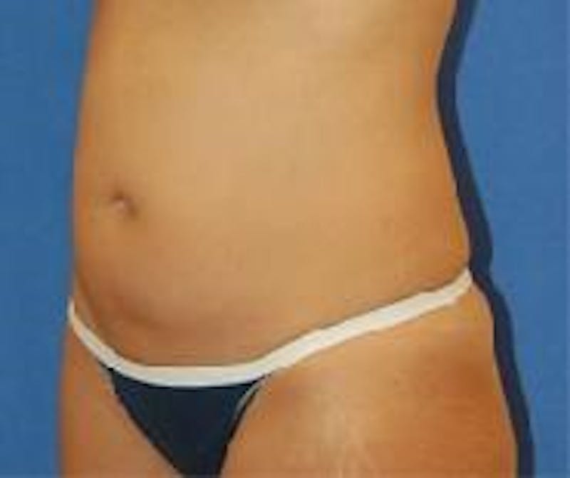 Liposuction Before & After Gallery - Patient 90404972 - Image 5