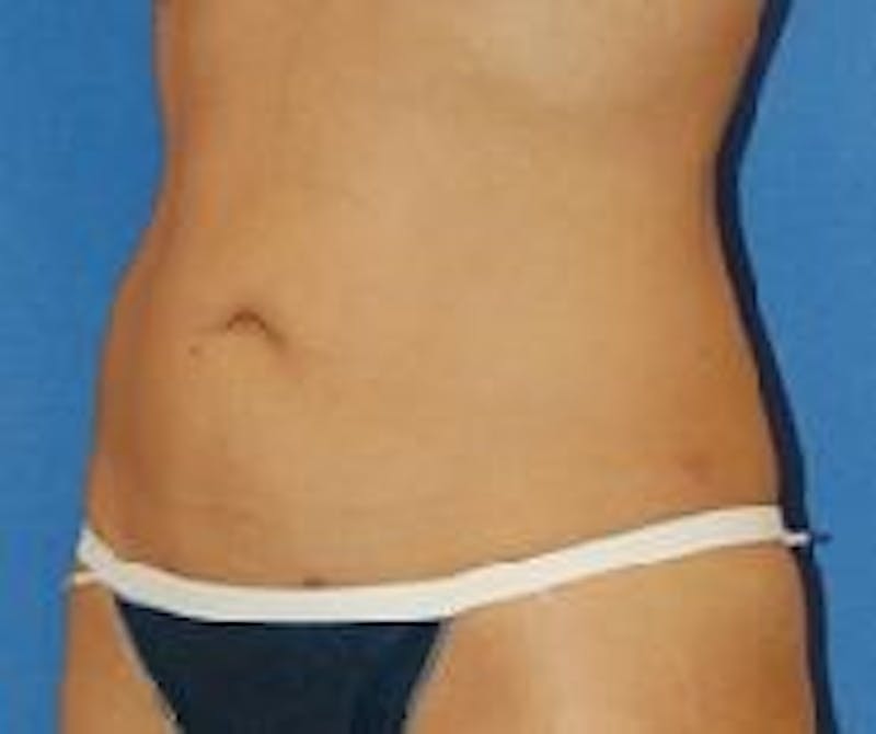 Liposuction Before & After Gallery - Patient 90404972 - Image 6