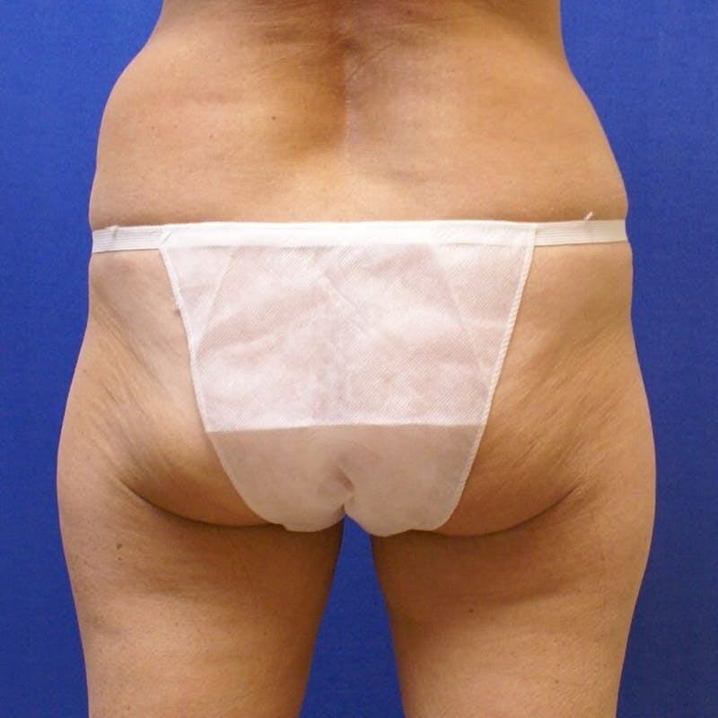 Liposuction Before & After Gallery - Patient 90404973 - Image 1
