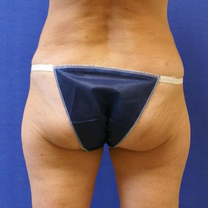 Liposuction Before & After Gallery - Patient 90404973 - Image 2
