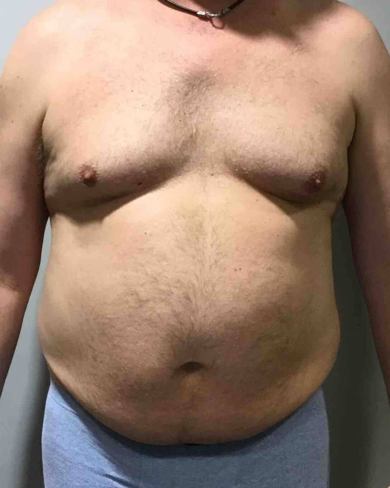 Liposuction Before & After Gallery - Patient 90404996 - Image 1