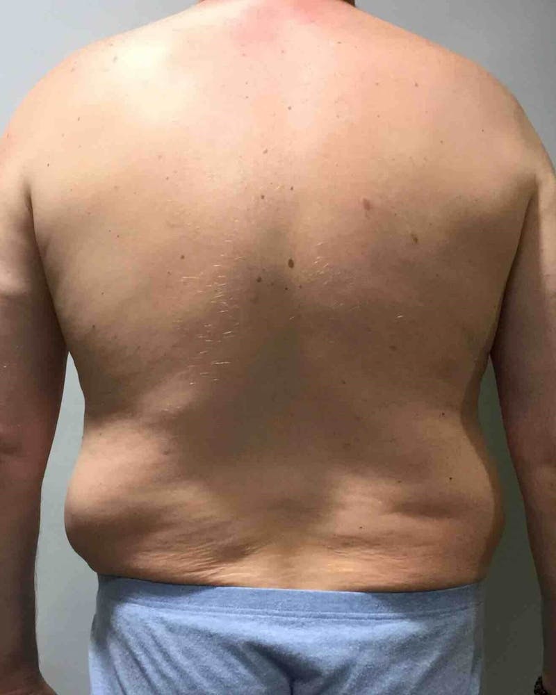 Liposuction Before & After Gallery - Patient 90404996 - Image 3