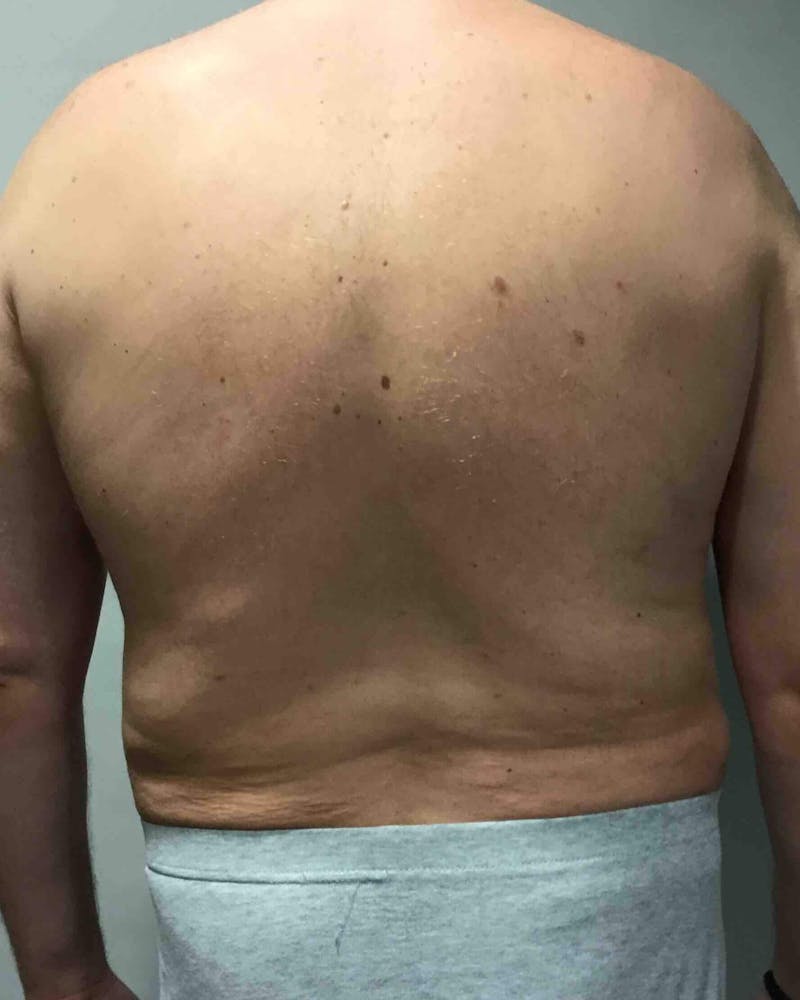 Liposuction Before & After Gallery - Patient 90404996 - Image 4