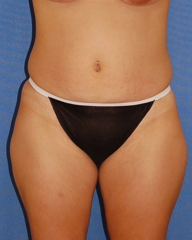 Liposuction Before & After Gallery - Patient 90404999 - Image 1