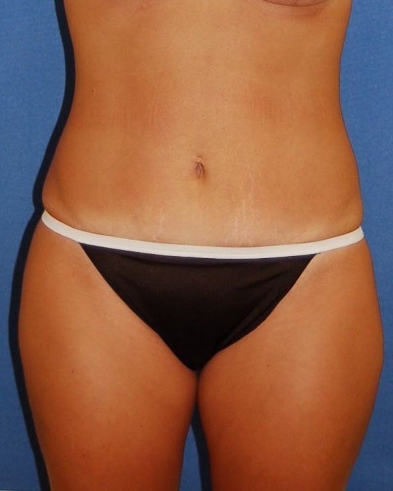 Liposuction Before & After Gallery - Patient 90404999 - Image 2