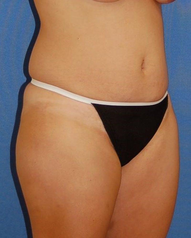 Liposuction Before & After Gallery - Patient 90404999 - Image 3