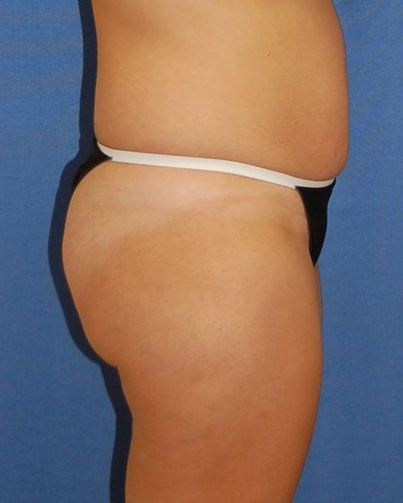 Liposuction Before & After Gallery - Patient 90404999 - Image 5