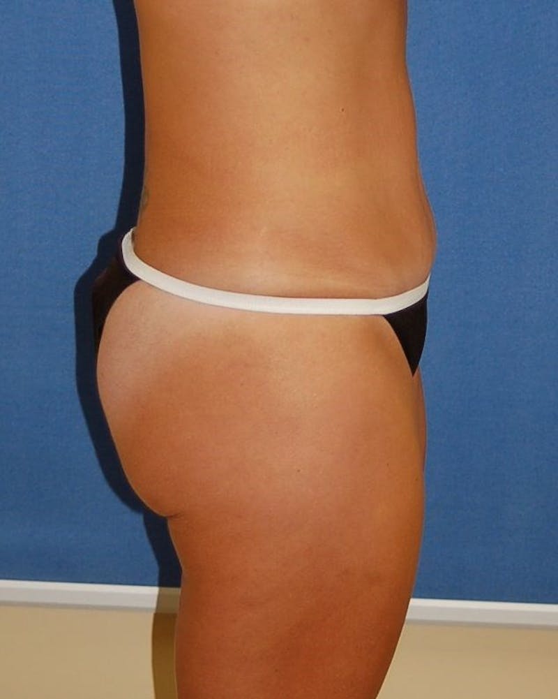 Liposuction Before & After Gallery - Patient 90404999 - Image 6