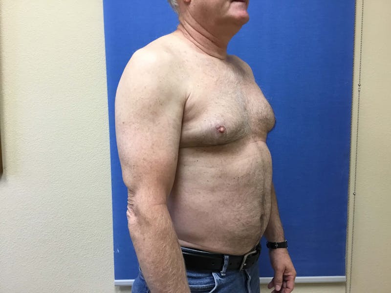 Liposuction Before & After Gallery - Patient 90405025 - Image 1