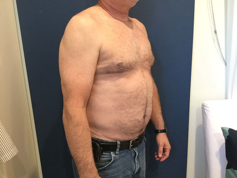 Liposuction Before & After Gallery - Patient 90405025 - Image 2