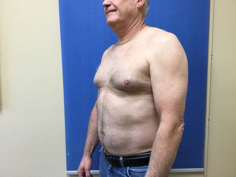 Liposuction Before & After Gallery - Patient 90405025 - Image 3