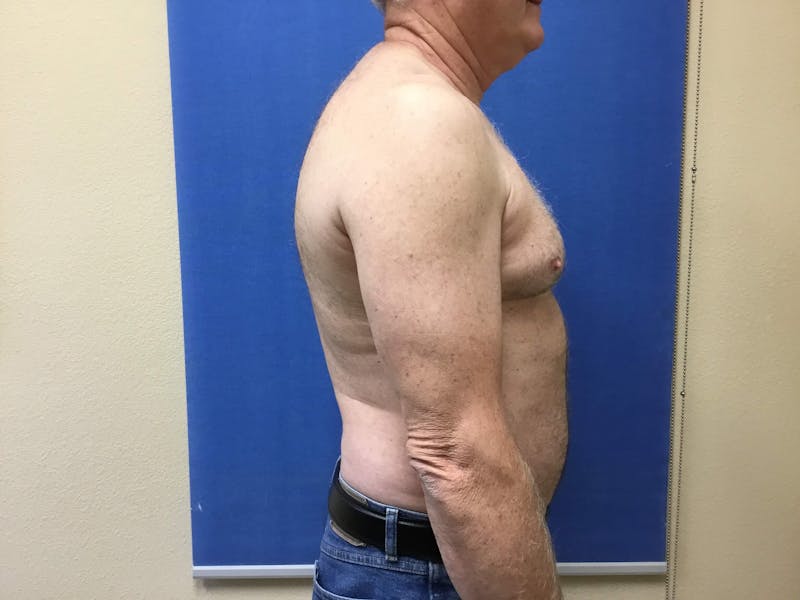 Liposuction Before & After Gallery - Patient 90405025 - Image 5