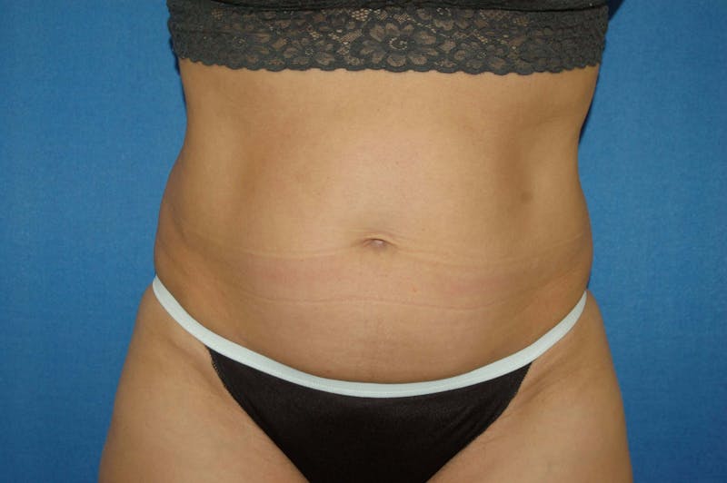 Liposuction Before & After Gallery - Patient 90407285 - Image 1
