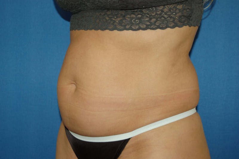 Liposuction Before & After Gallery - Patient 90407285 - Image 3