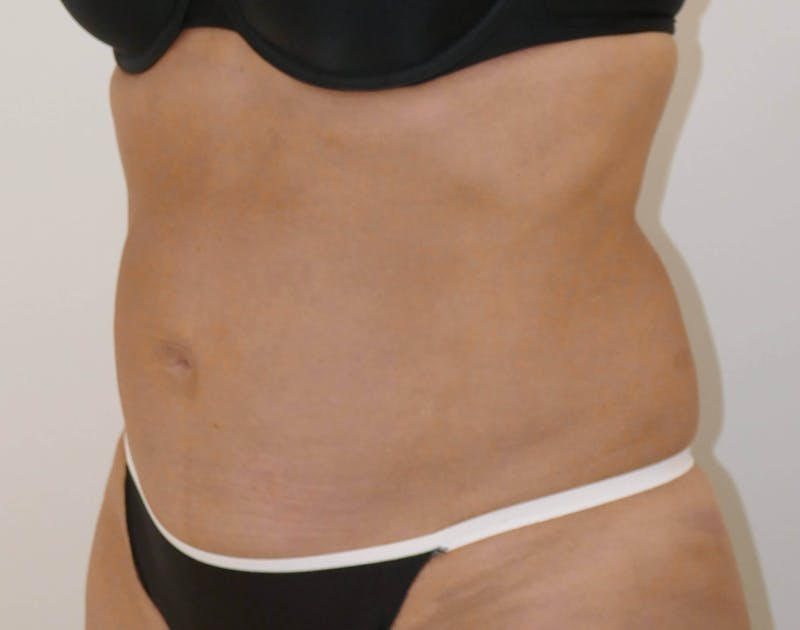 Liposuction Before & After Gallery - Patient 90407285 - Image 4