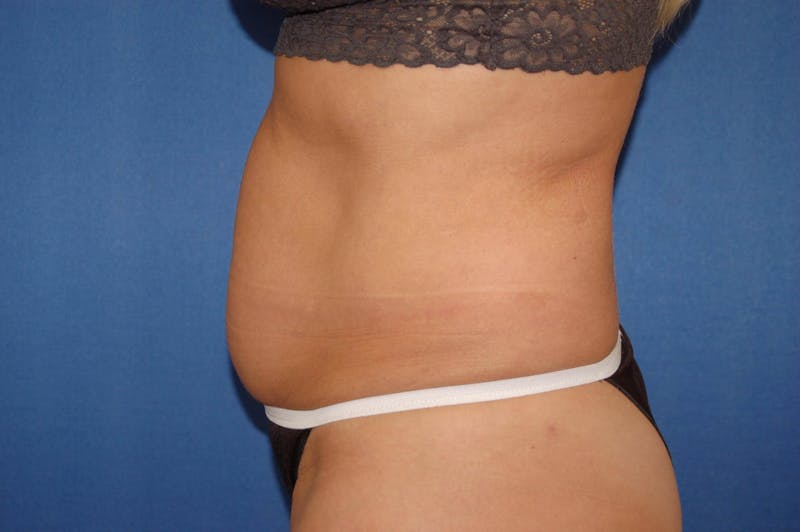 Liposuction Before & After Gallery - Patient 90407285 - Image 5