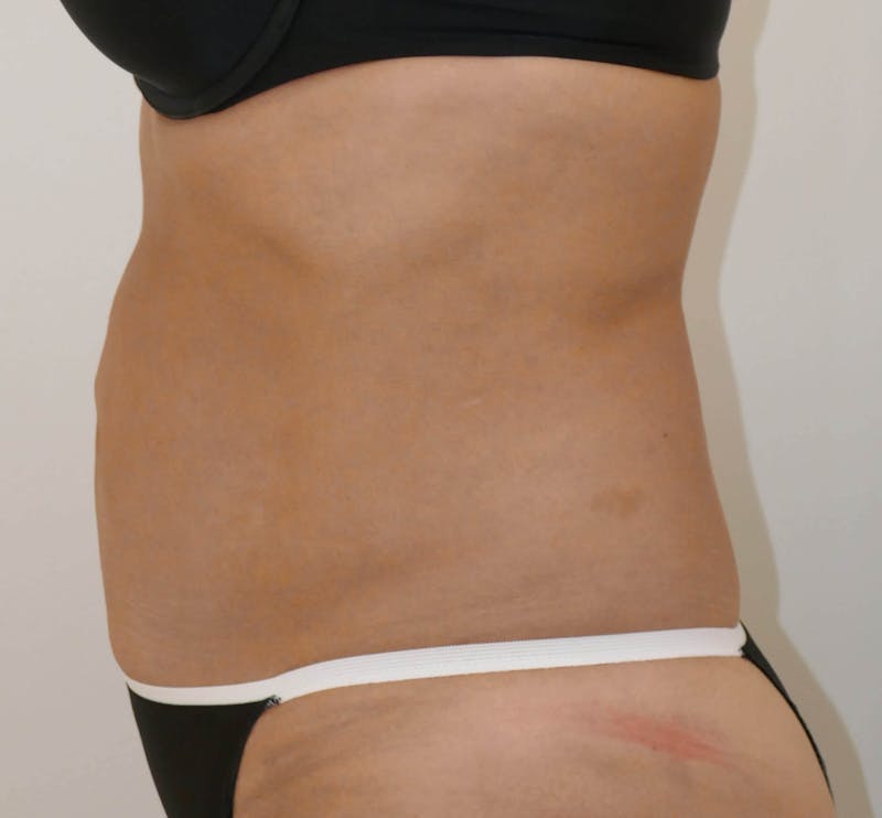 Liposuction Gallery - Patient 90407285 - Image 6