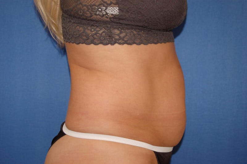 Liposuction Before & After Gallery - Patient 90407285 - Image 7