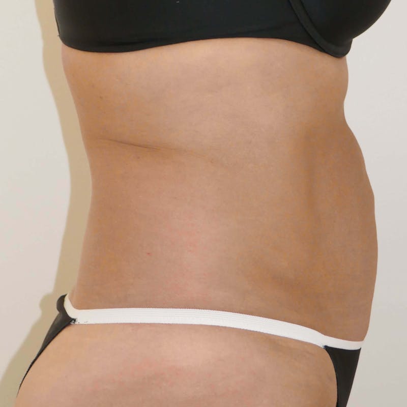 Liposuction Before & After Gallery - Patient 90407285 - Image 8