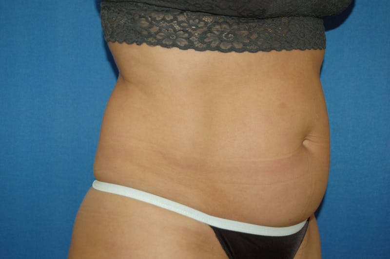Liposuction Before & After Gallery - Patient 90407285 - Image 9