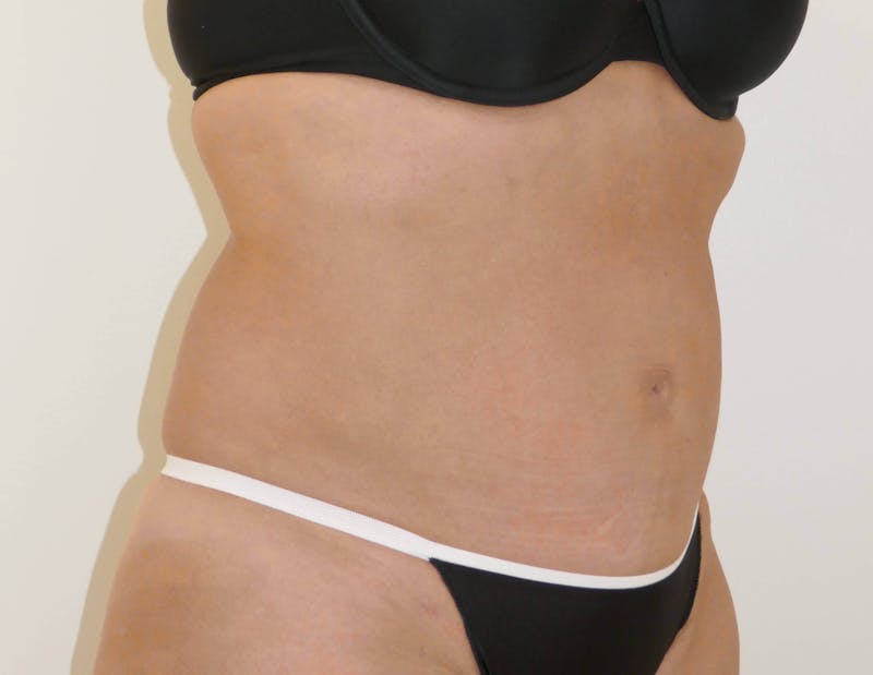 Liposuction Gallery - Patient 90407285 - Image 10