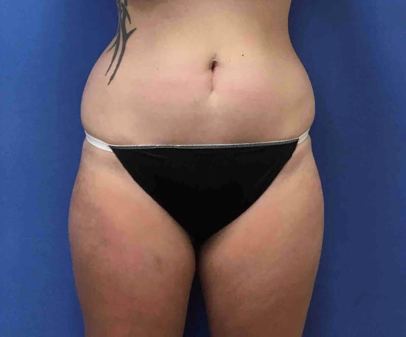Liposuction Before & After Gallery - Patient 90407286 - Image 1