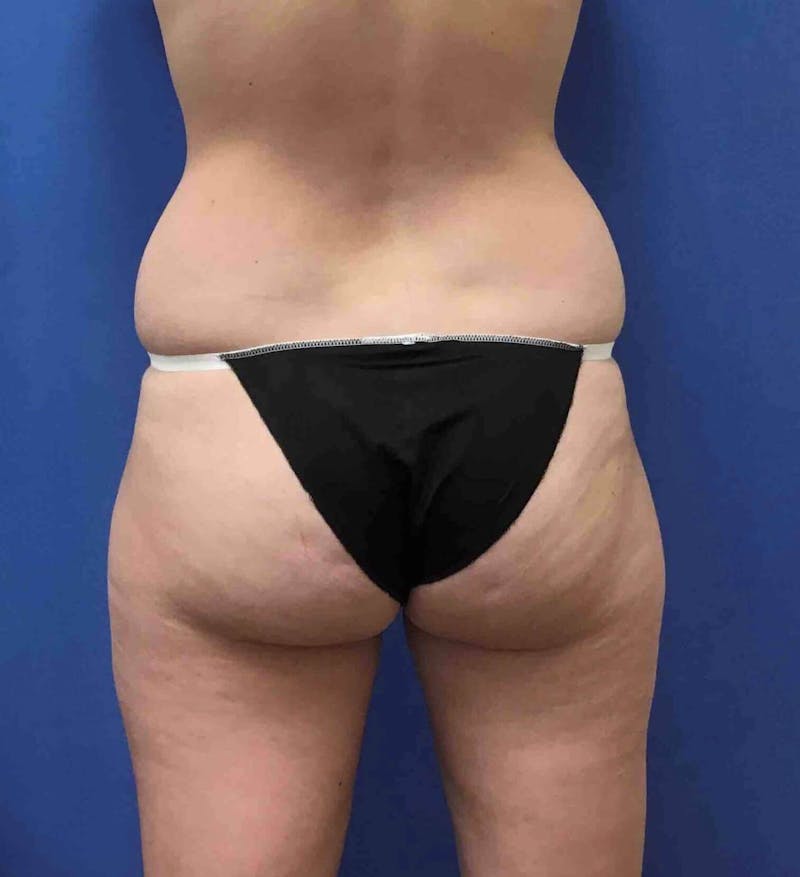 Liposuction Before & After Gallery - Patient 90407286 - Image 3