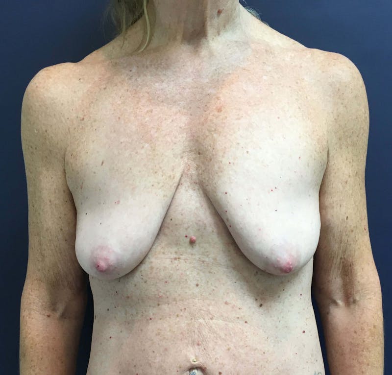 Breast Lift (Mastopexy) Before & After Gallery - Patient 90411868 - Image 1