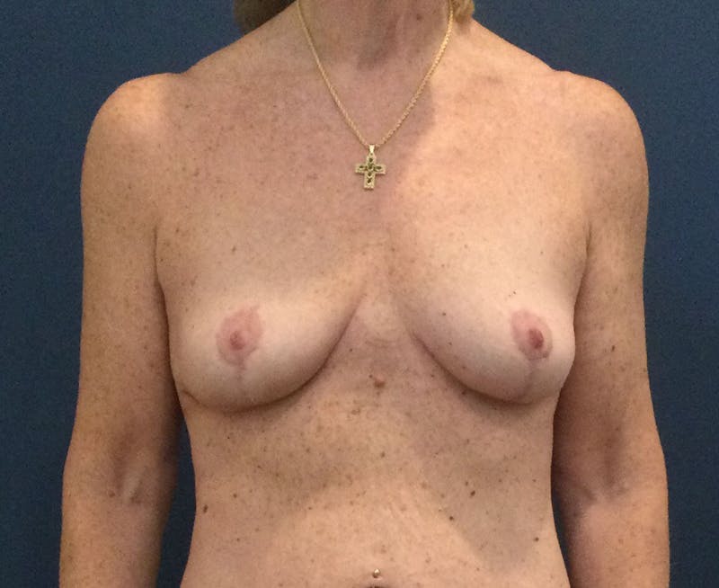 Breast Lift (Mastopexy) Before & After Gallery - Patient 90411868 - Image 2