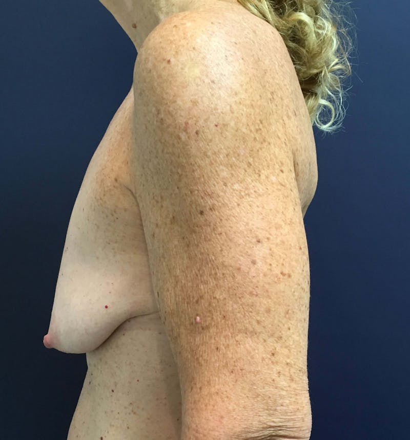 Breast Lift (Mastopexy) Before & After Gallery - Patient 90411868 - Image 3