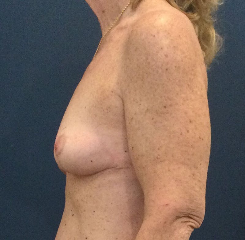 Breast Lift (Mastopexy) Before & After Gallery - Patient 90411868 - Image 4