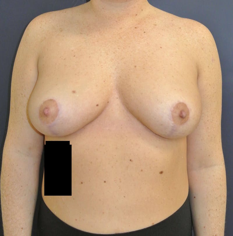 Breast Lift (Mastopexy) Before & After Gallery - Patient 90411873 - Image 2