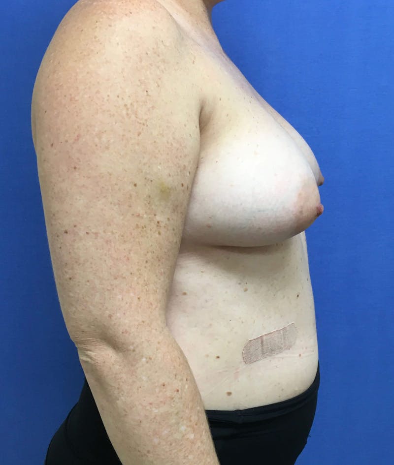 Breast Lift (Mastopexy) Before & After Gallery - Patient 90411873 - Image 3