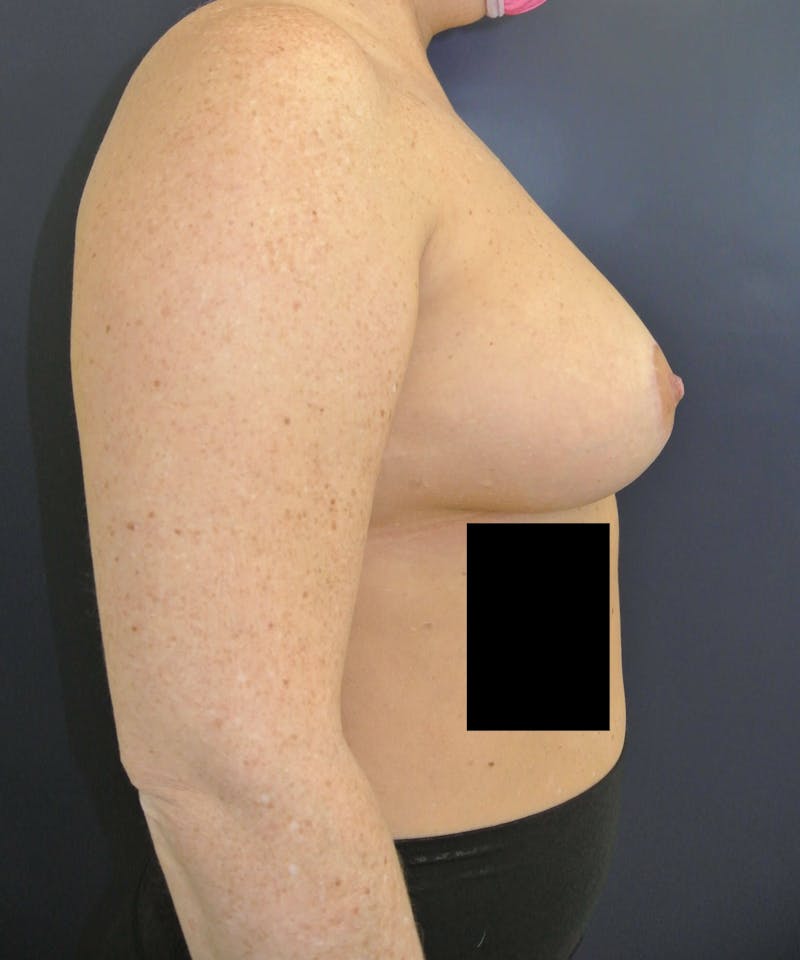Breast Lift (Mastopexy) Before & After Gallery - Patient 90411873 - Image 4
