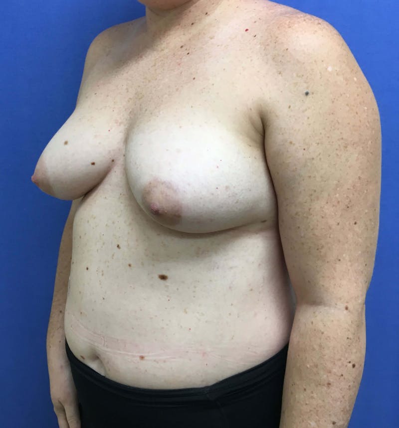 Breast Lift (Mastopexy) Before & After Gallery - Patient 90411873 - Image 5