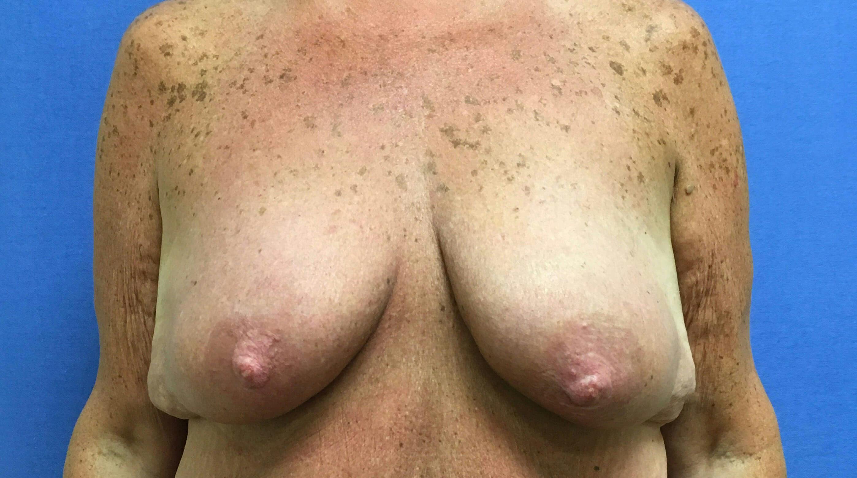Breast Lift (Mastopexy) Gallery - Patient 90411887 - Image 1