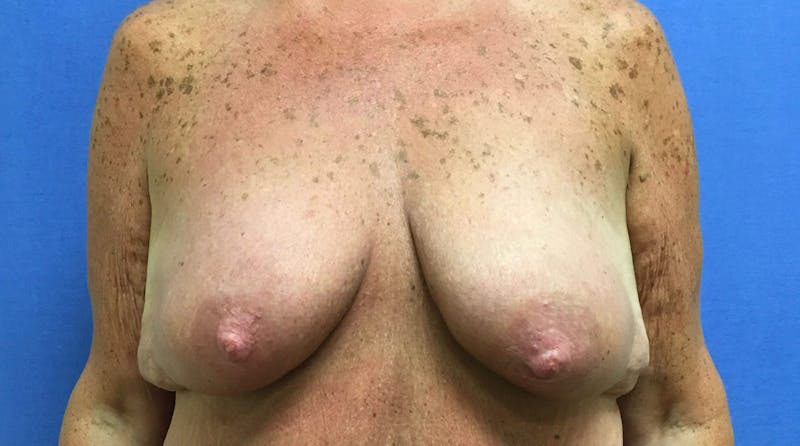 Breast Lift (Mastopexy) Before & After Gallery - Patient 90411887 - Image 1