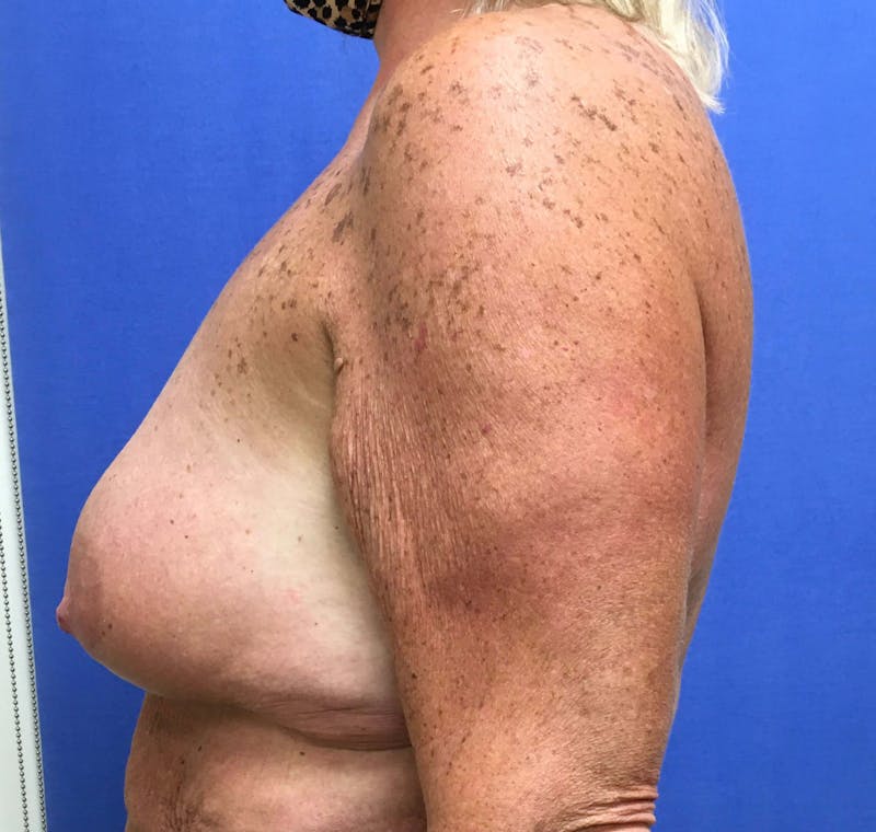 Breast Lift (Mastopexy) Before & After Gallery - Patient 90411887 - Image 3