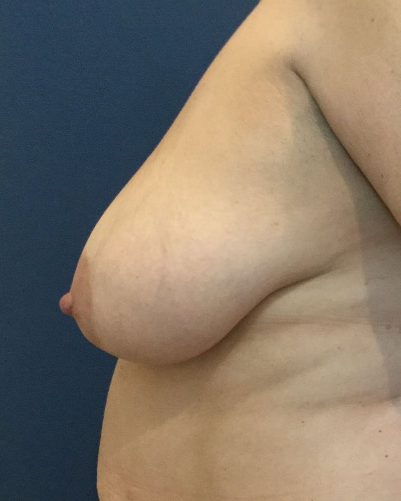 Breast Lift (Mastopexy) Before & After Gallery - Patient 90416130 - Image 5