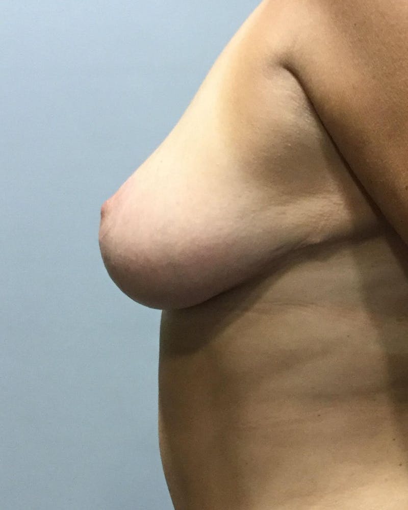 Breast Lift (Mastopexy) Before & After Gallery - Patient 90416130 - Image 6